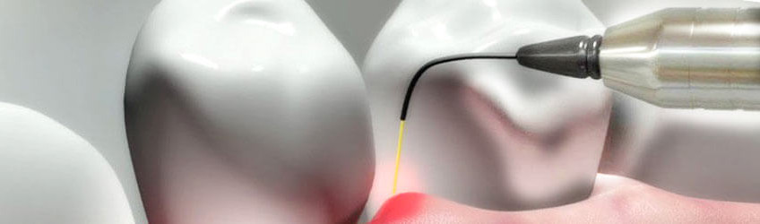 850x250-Laser-Dentistry